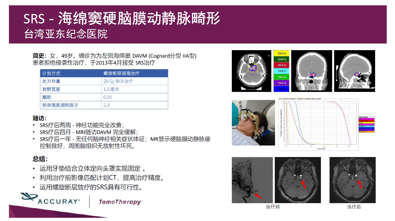 台湾亚东纪念医院-海绵窦硬脑膜瘤动静脉畸形SRS.png
